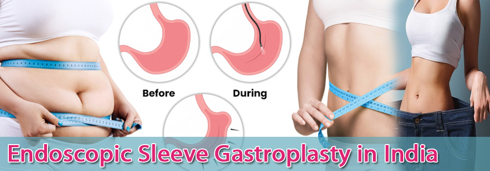 Low Cost Endoscopic Sleeve Gastroplasty Surgery in India